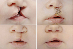Lip Repair